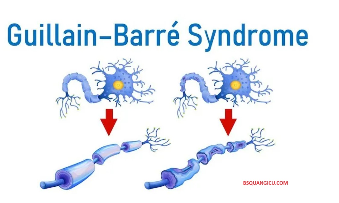 HỘI CHỨNG GUILLAIN – BARRE