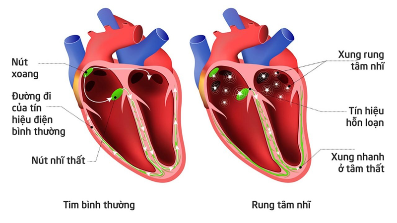 NGỘ ĐỘC CẤP CÁC CHẤT GÂY RỐI LOẠN NHỊP TIM