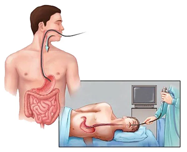 RỬA DẠ DÀY TRONG NGỘ ĐỘC CẤP