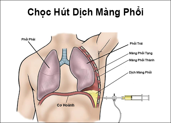 KỸ THUẬT CHỌC HÚT VÀ DẪN LƯU MÀNG PHỔI