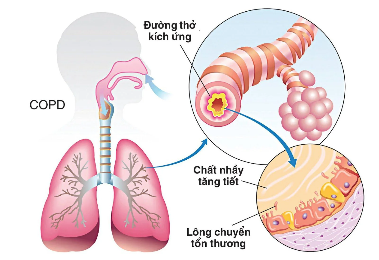 THÔNG KHÍ CƠ HỌC TRONG ĐIỀU TRỊ SUY HÔ HẤP CẤP DO HEN PHẾ QUẢN VÀ BỆNH PHỔI TẮC NGHẼN MẠN TÍNH