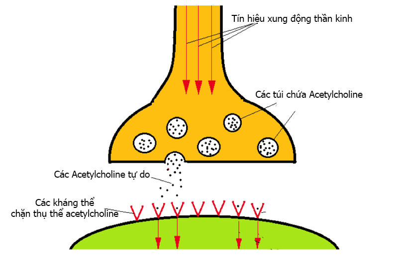 CƠN NHƯỢC CƠ NẶNG