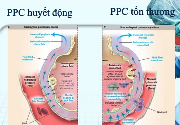 CHẨN ĐOÁN VÀ XỬ TRÍ PHỦ PHỐI CẤP HUYẾT ĐỘNG