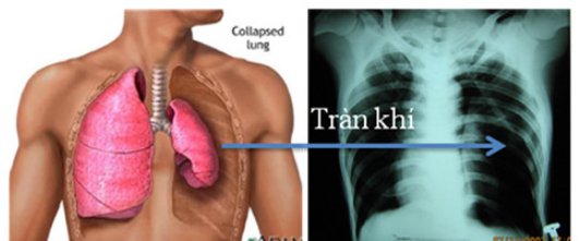 CHẨN ĐOÁN VÀ ĐIỀU TRỊ TRÀN KHÍ MÀNG PHỐI