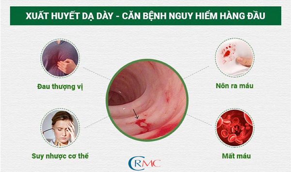 CHẨN ĐOÁN VÀ XỬ TRÍ XUẤT HUYẾT TIÊU HÓA CAO