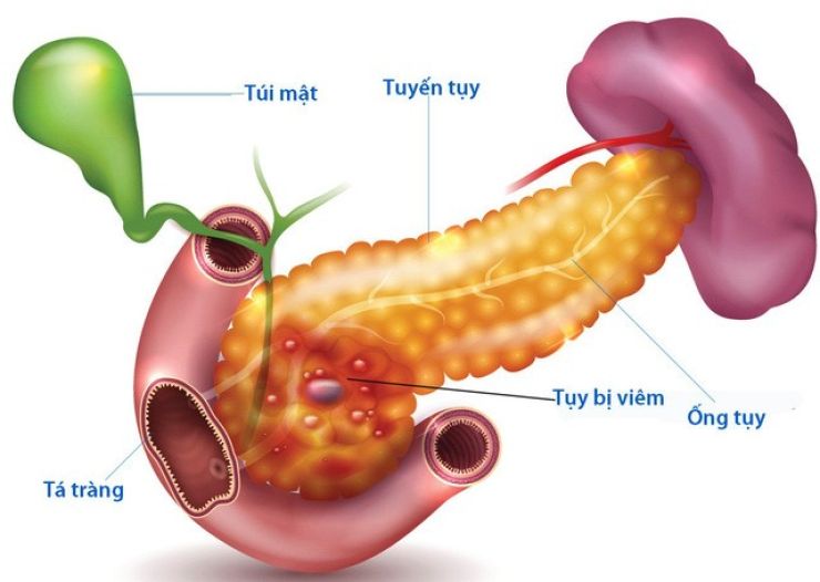 VIÊM TỤY CẤP NẶNG