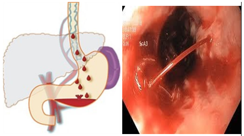 CHẨN ĐOÁN VÀ XỬ TRÍ XUẤT HUYẾT TIÊU HÓA CAO